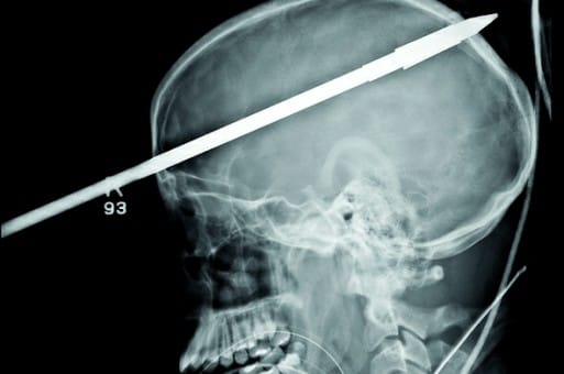 استخراج رمح اخترق جمجمة مراهق وخرج من الخلف