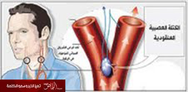 تطوير إجراء جراحي يقضي نهائياً على ارتفاع ضغط الدم