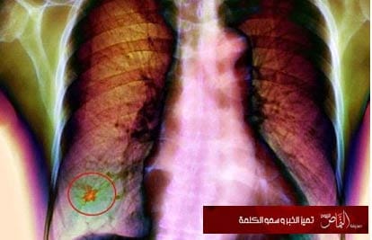 اخطاء واوهام عن التدخين وسرطان الرئة